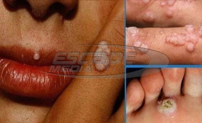 Κονδυλώματα: Αν δείτε αυτά τα σημάδια στο σώμα, κάντε εξέταση!