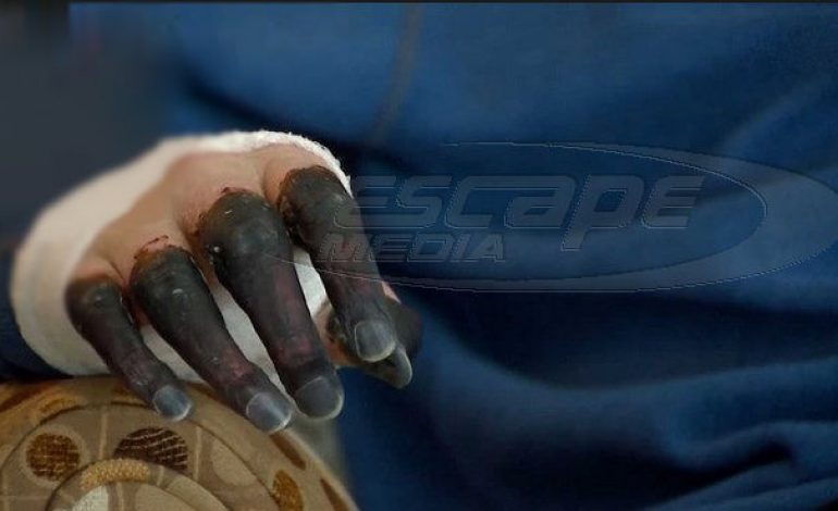Μολύνθηκε από στρεπτόκοκκο κι έχασε τα άκρα του