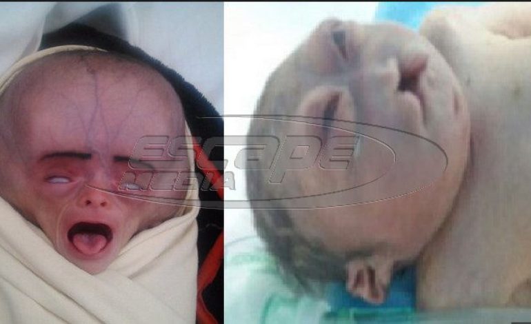 Σοβαρές παραμορφώσεις από τον πόλεμο στην Υεμένη
