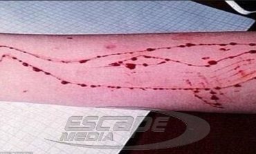 «ΜΠΛΕ ΦΑΛΑΙΝΑ»! Νέο κρούσμα στην Τούμπα με θύμα 14χρονη