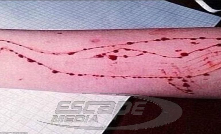 «ΜΠΛΕ ΦΑΛΑΙΝΑ»! Νέο κρούσμα στην Τούμπα με θύμα 14χρονη