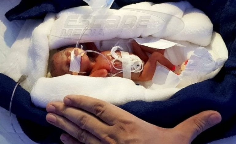 Ένας πραγματικός μαχητής: Αυτό το πρόωρο μωράκι ζύγιζε μόλις 400 γραμμάρια αλλά κατάφερε να επιβιώσει!