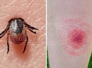 Νόσος του Lyme (βορρελίωση)