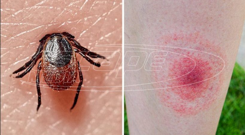 Νόσος του Lyme (βορρελίωση)